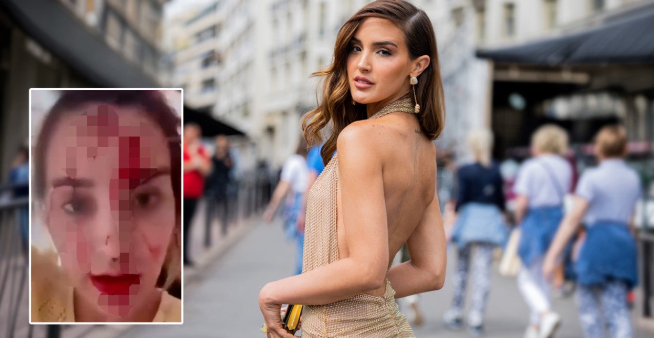 Video  Sulmohet në Kanë  Miss Venezuela 2025   publikon fytyrën e mbuluar me gjak
