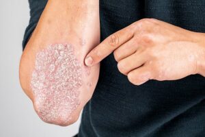 Psoriaza, hap i madh në mjekësi: