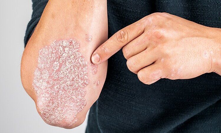Psoriaza, hap i madh në mjekësi:
